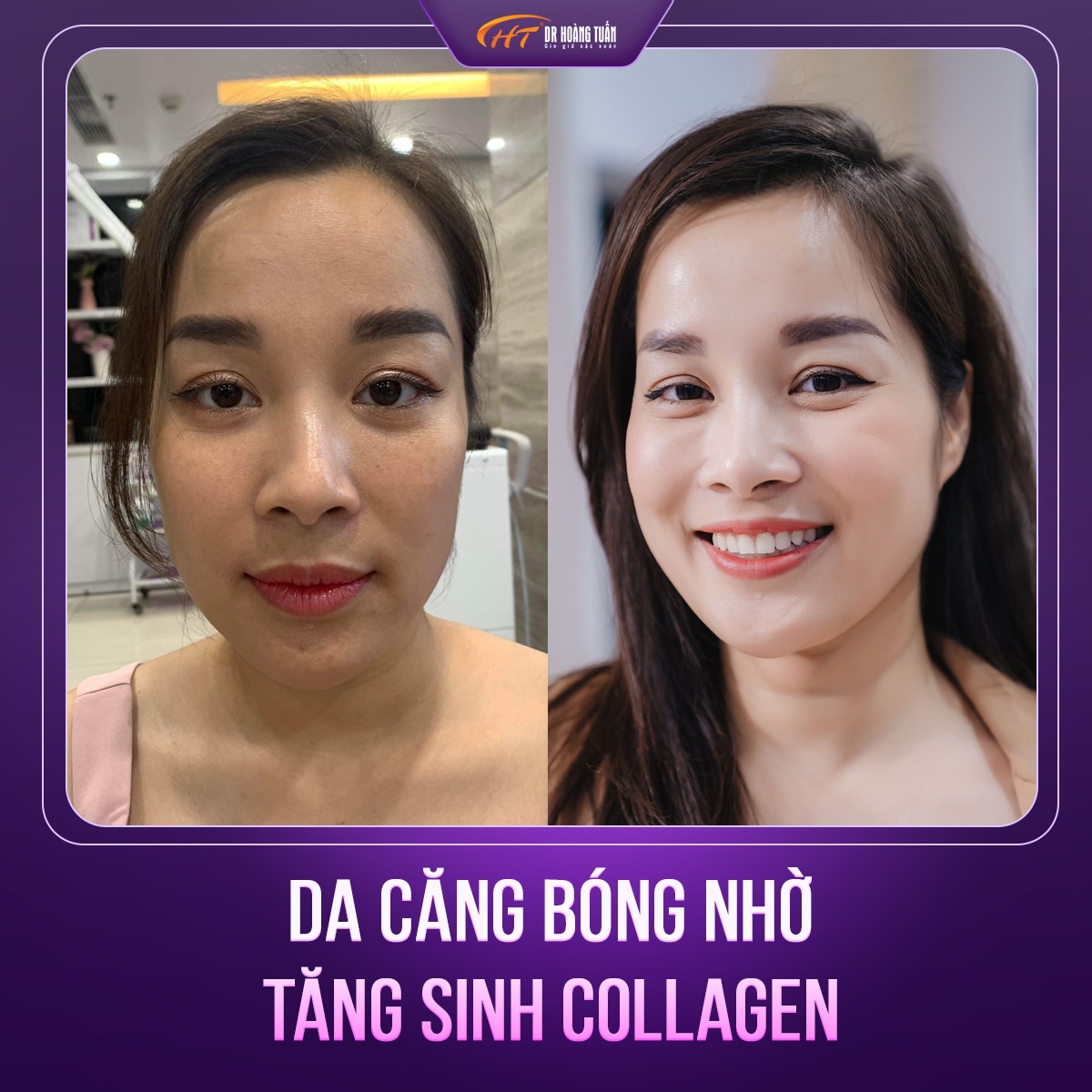 review tiêm BAP 5 điểm